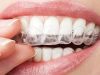 Veneers Vs. Braces: Which Is Right For You?