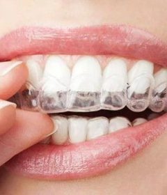 Veneers Vs. Braces: Which Is Right For You?